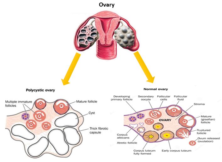 Polycystic Ovary Syndrome: pathogenesis, management, and treatment with metals and organic compounds 