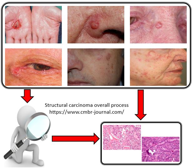 Structural carcinoma overall process: a systematic review 